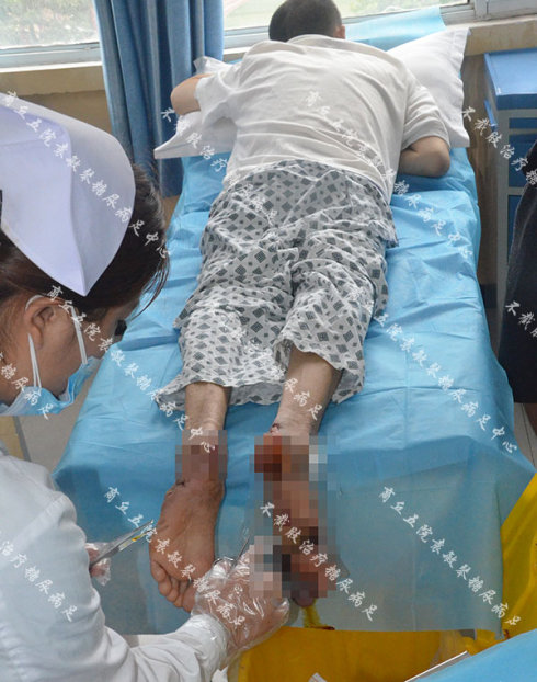 商丘五院案例:年纪较大的糖尿病足患者怎么缓解疼痛?