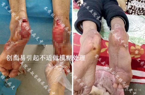 商丘五院案例:年纪较大的糖尿病足患者怎么缓解疼痛?