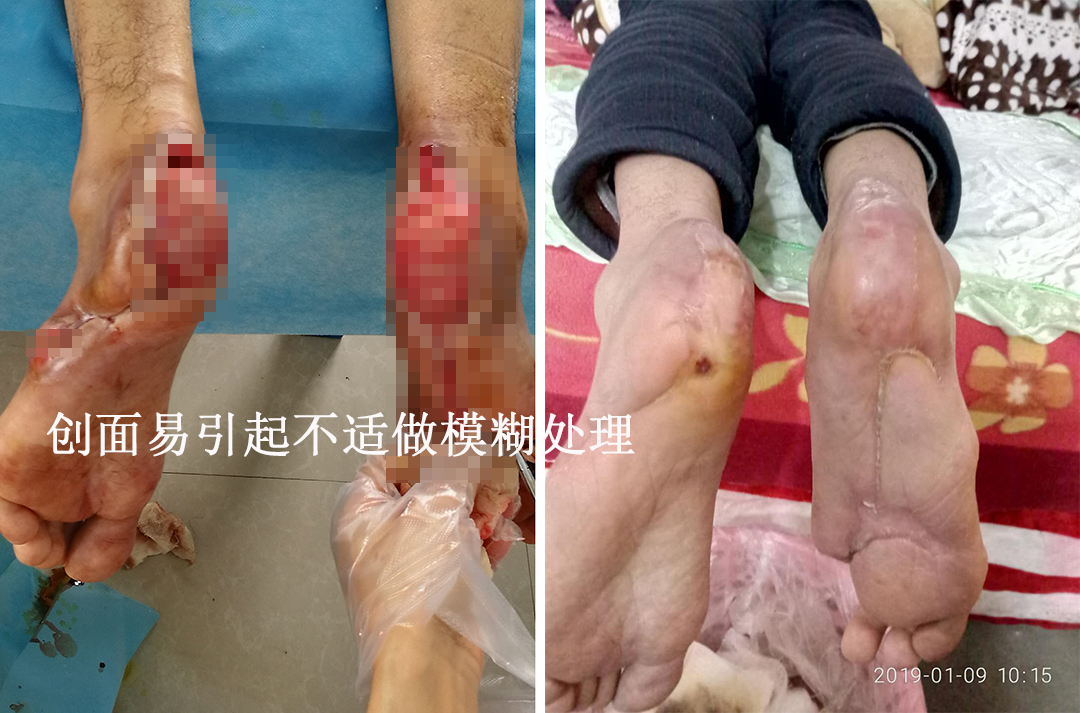一个典型案例告诉大家,糖尿病足可以通过中西医开放式疗法保肢痊愈