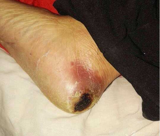 糖尿病烂脚合并尿毒症病人的治疗经历,最后还是中医保守治好了