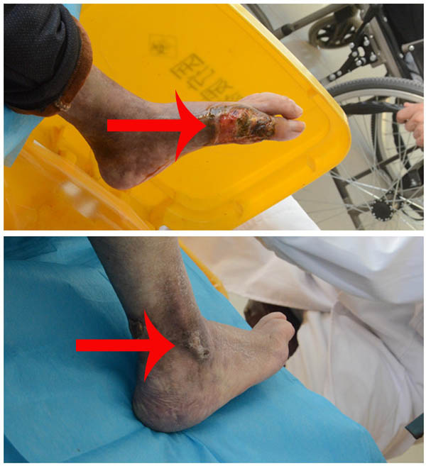 治疗十多家医院终要截肢,护理老前辈终于打赢与糖尿病足的斗争!