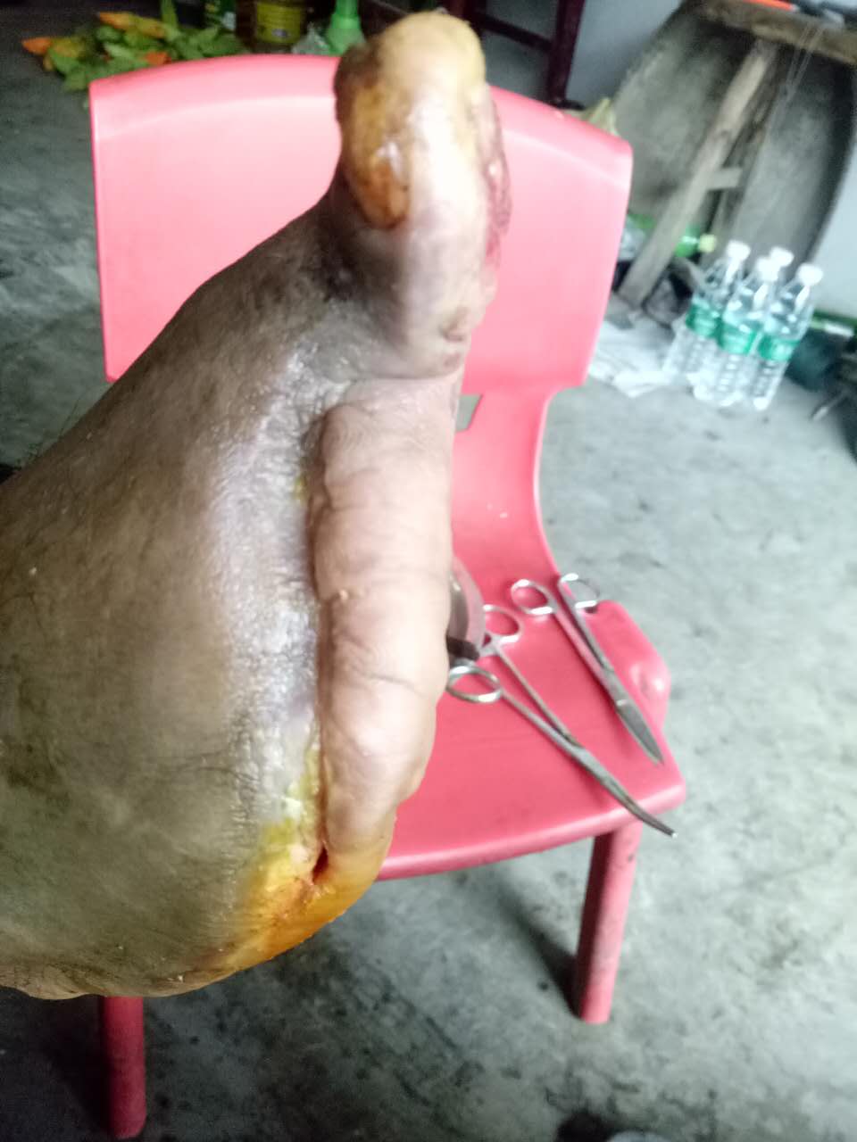 案例:糖尿病患者因为脚脱皮处理不当出现伤口,脚趾坏死的保守不截肢治疗