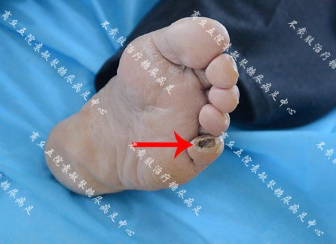 糖尿病人脚底长鸡眼导致溃烂发黑,什么方法治疗最有效?