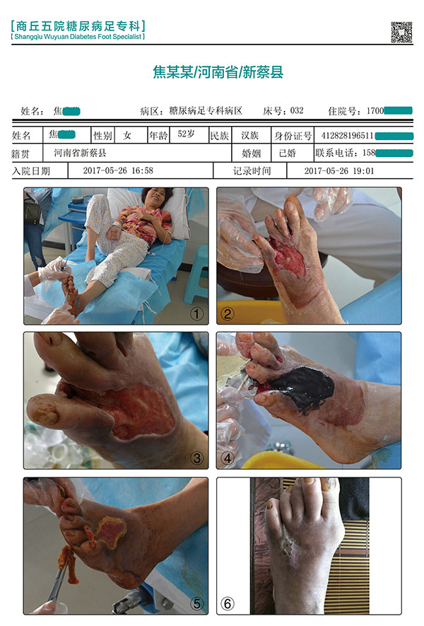 糖尿病患者得了烂脚,身体发烧不退不截肢可以吗