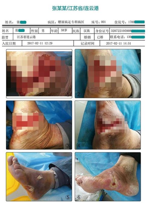 导致糖尿病足患者从小伤到截肢什么原因？