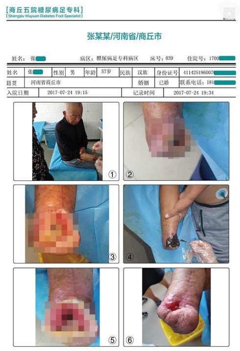 检查糖尿病足要检查血管,导致烂脚的原因还有哪些?