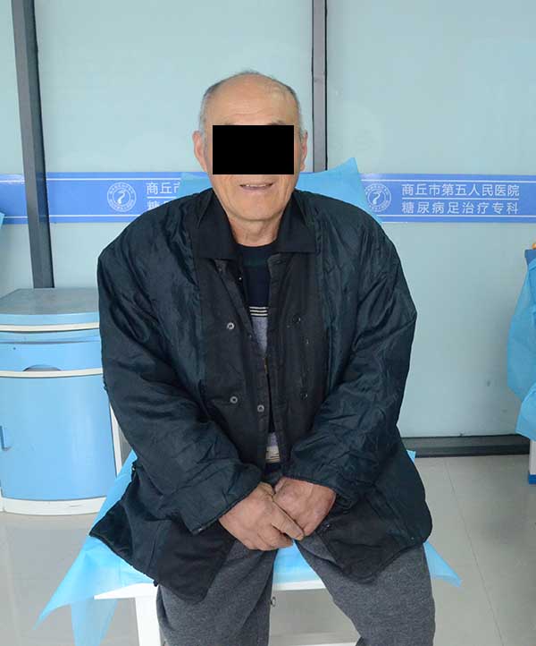糖尿病足医院要截肢治疗,没有办法保守治疗吗?