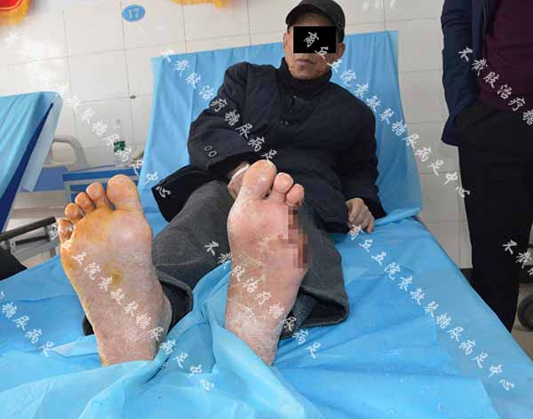 康复案例:糖尿病烂脚脚趾截除缝合伤口又感染能保守治吗