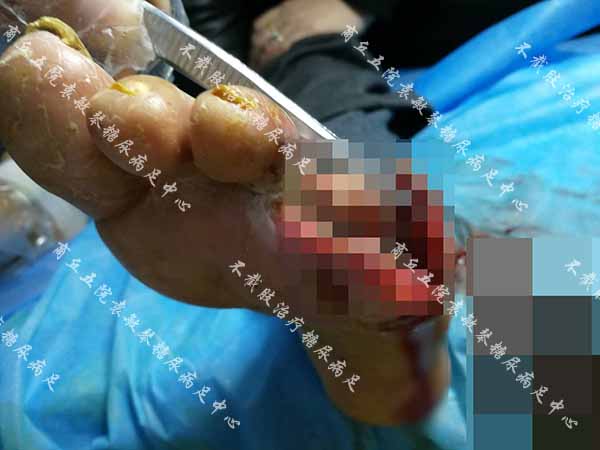 康复案例:糖尿病烂脚脚趾截除缝合伤口又感染能保守治吗