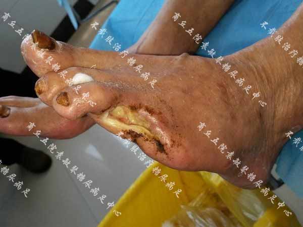 康复案例:糖尿病烂脚脚趾截除缝合伤口又感染能保守治吗
