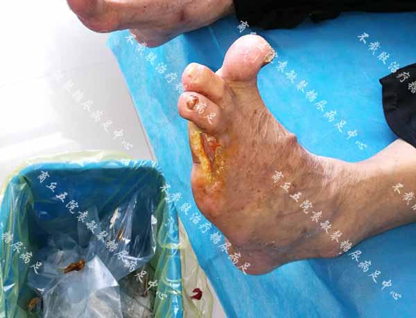康复案例:糖尿病烂脚脚趾截除缝合伤口又感染能保守治吗