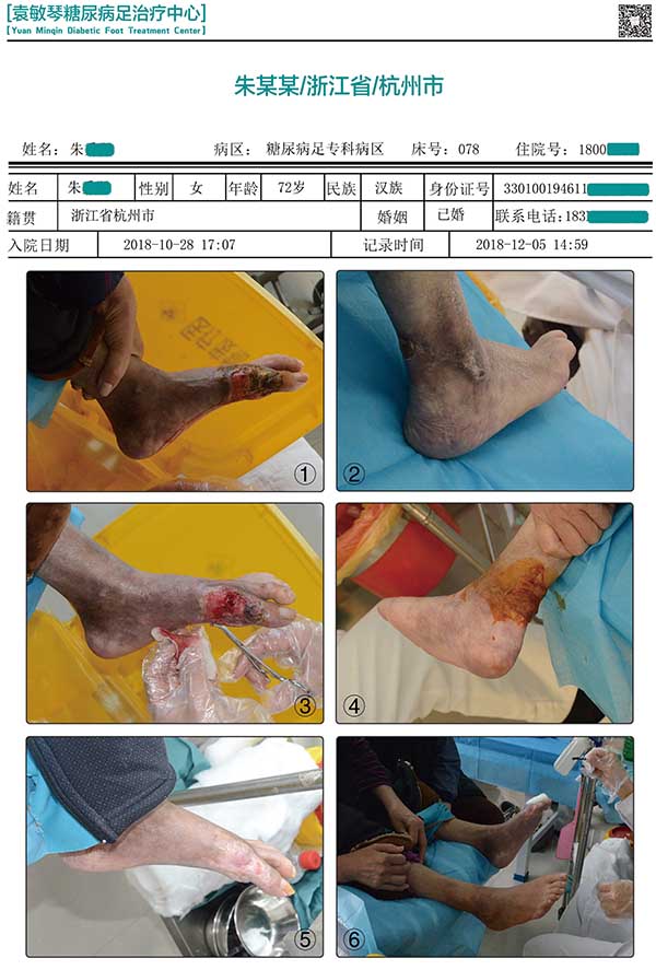 糖尿病人出现烂脚一直治不好,中西医结合真的能保守治疗吗?