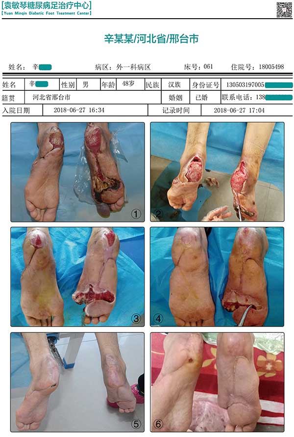 糖尿病人出现烂脚一直治不好,中西医结合真的能保守治疗吗?