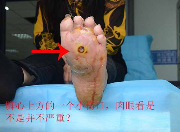 典型案例:糖尿病脚上只是一个小伤口,为什么一直流脓肿胀疼痛厉害?