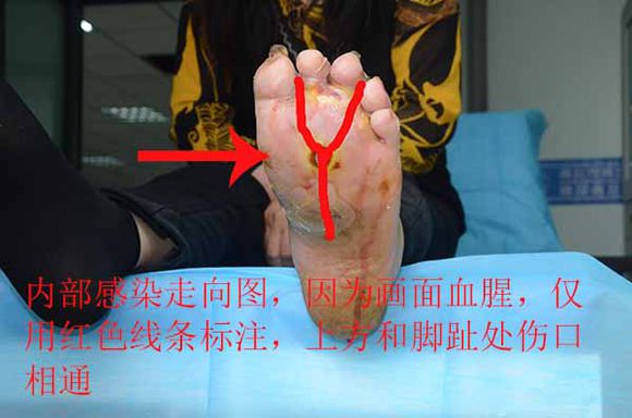 典型案例:糖尿病脚上只是一个小伤口,为什么一直流脓肿胀疼痛厉害?