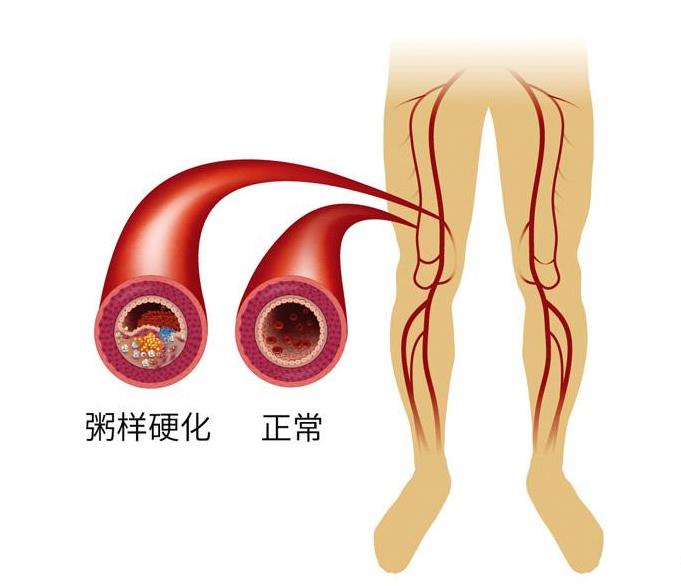 袁敏琴:糖尿病患者合并下肢动脉闭塞症很严重要尽快治疗!