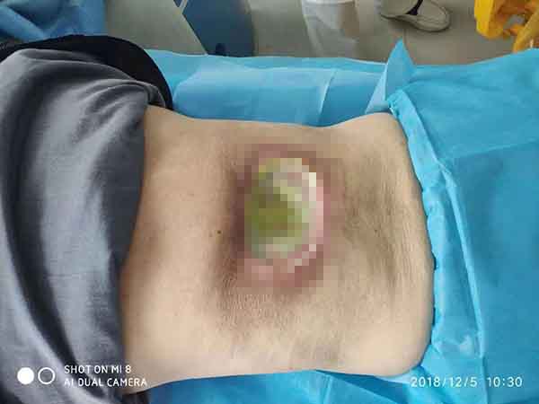 康复案例:糖尿病人后背伤口感染做骨水泥和负压引流越治越严重的治疗
