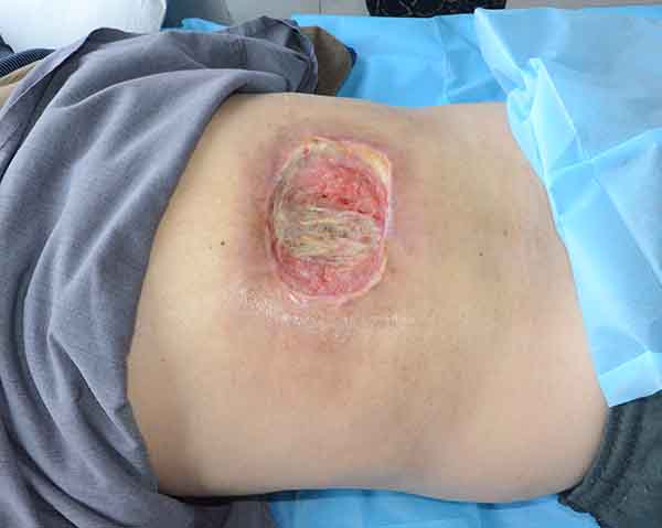 康复案例:糖尿病人后背伤口感染做骨水泥和负压引流越治越严重的治疗