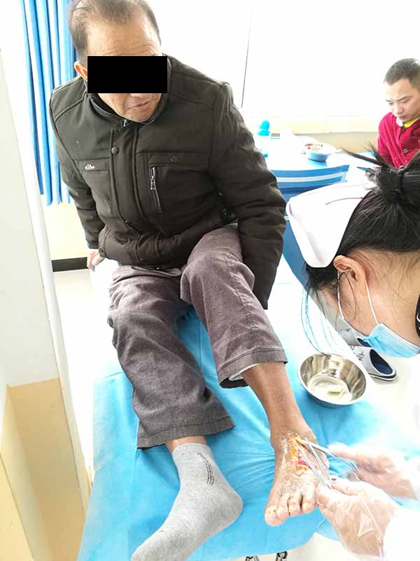 引起糖尿病烂脚的原因不只有血糖高,还有心、肾、脑、及个人生活习惯