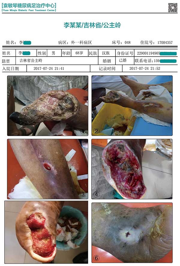 糖尿病足严重的话是否需要截肢?看一个内分泌科医生是怎么回答的! 图 只是一个脚趾感染和坏疽,医生就建议截肢,这是为病人的健康着想吗