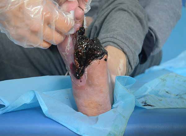 治疗糖尿病足伤口感染中药膏有去腐生肌的效果是不是真的?