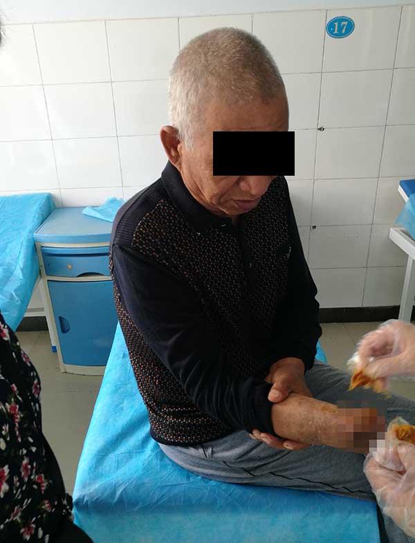 案例:糖尿病人上肢骨折截肢后引起的伤口感染与治疗