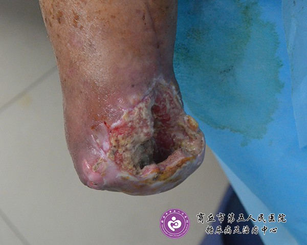 案例:糖尿病人上肢骨折截肢后引起的伤口感染与治疗