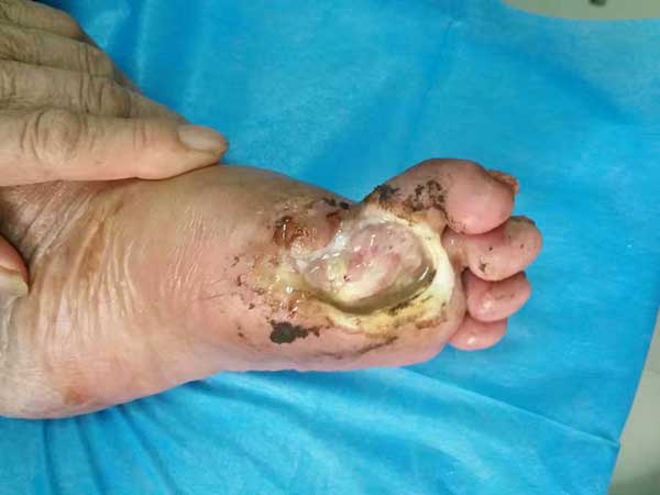 糖尿病足治好后复发率高不高?怎么预防糖尿病烂脚再次复发?
