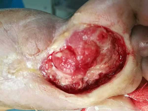 糖尿病足治好后复发率高不高?怎么预防糖尿病烂脚再次复发?