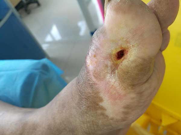 封闭式负压引流技术治疗糖尿病足效果究竟好不好?