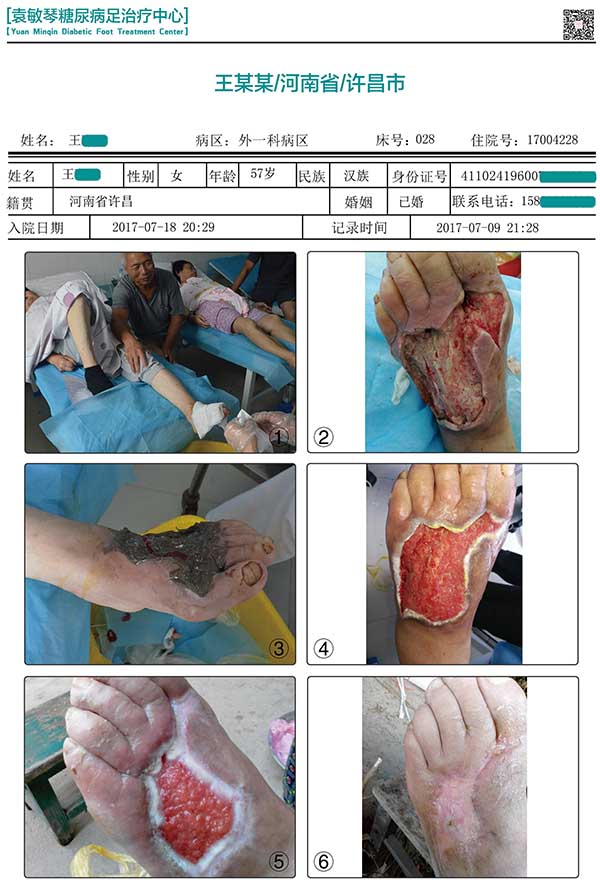 袁敏琴:糖尿病足患者是不是截肢了就能好了?