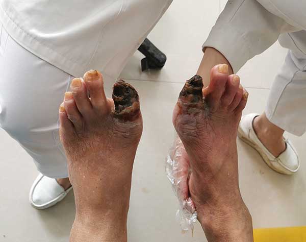 袁敏琴糖尿病干性坏疽截肢是最好的方法吗