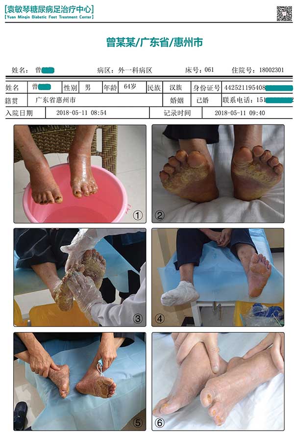 袁敏琴:导致糖尿病烂脚的原因都有哪些?