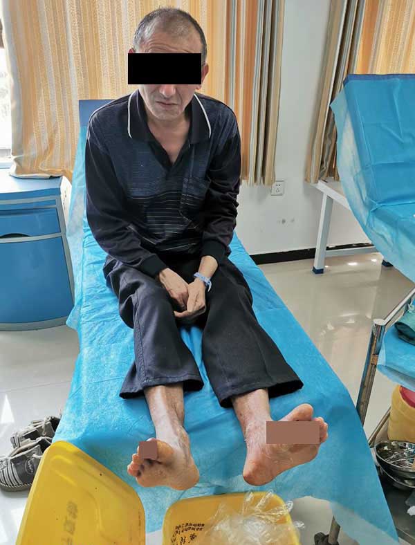 糖尿病足患者割鸡眼,双脚伤口感染不愈合,不截肢能治好吗?