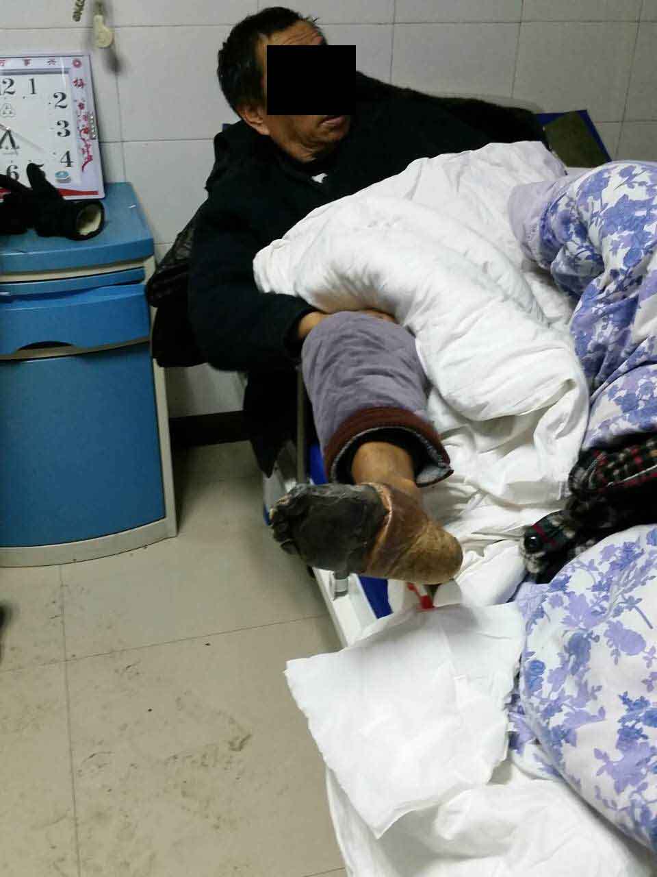 糖尿病足干性坏疽很严重,到底能不能保肢?