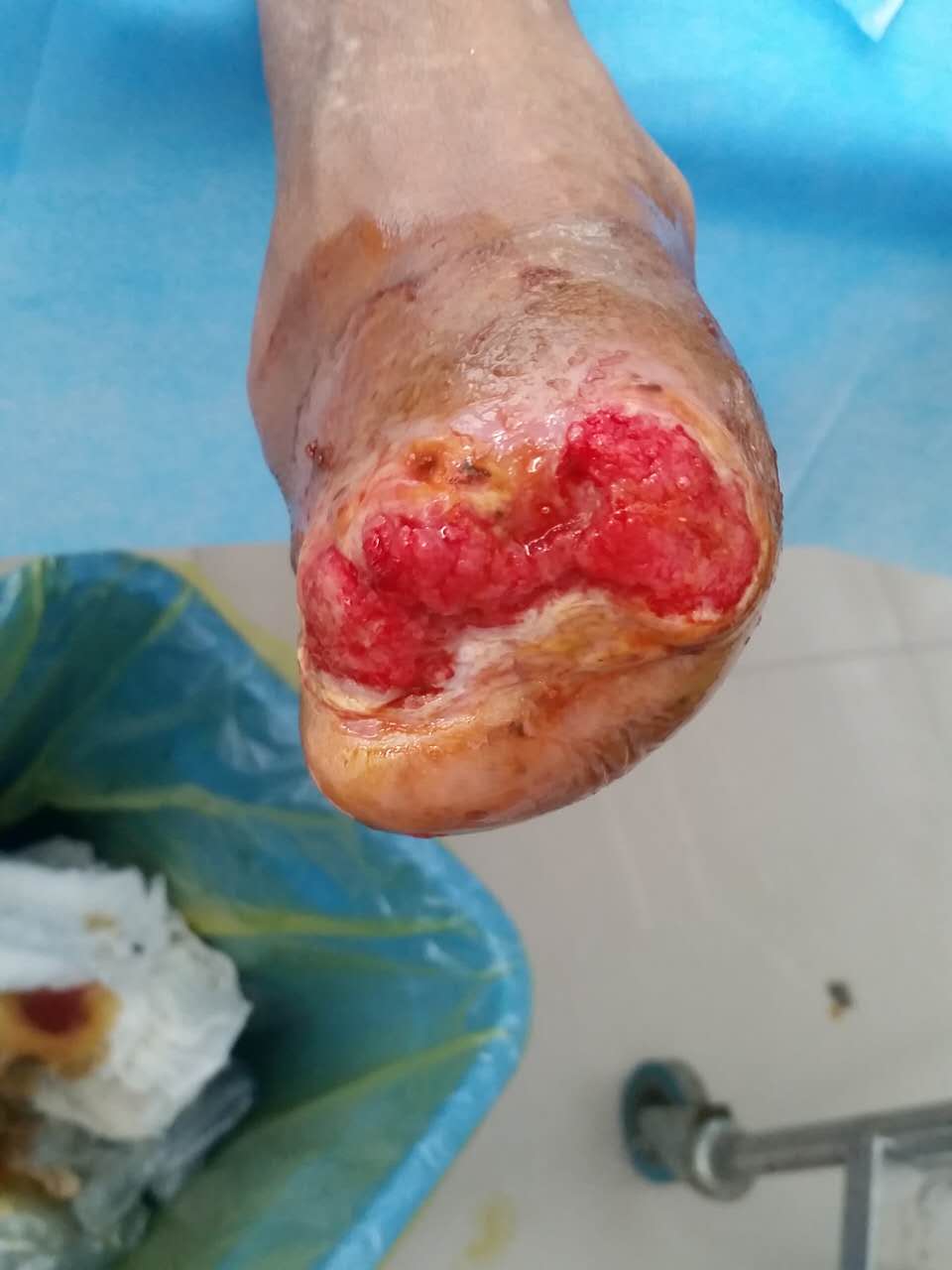 糖尿病足干性坏疽很严重,到底能不能保肢?