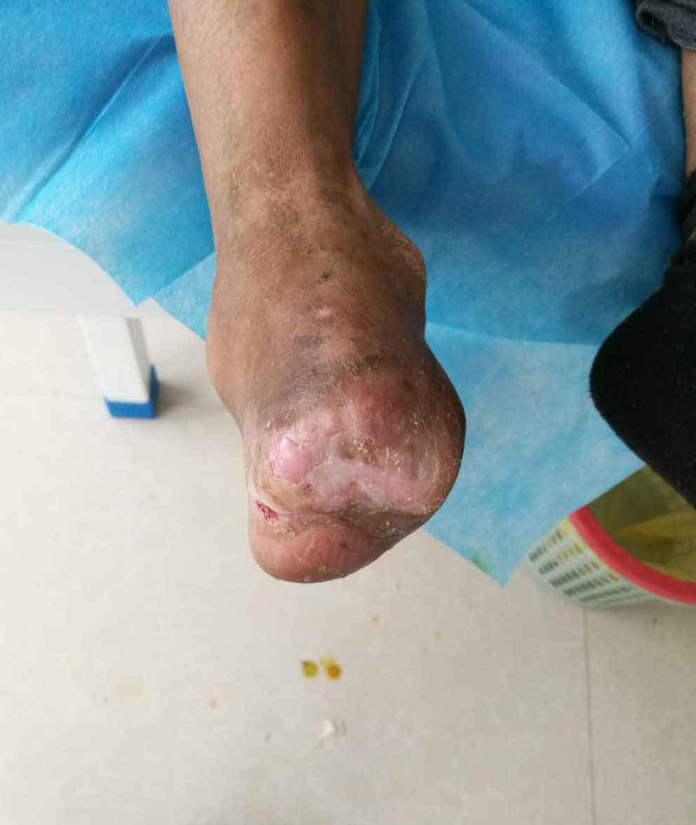 糖尿病足干性坏疽很严重,到底能不能保肢?