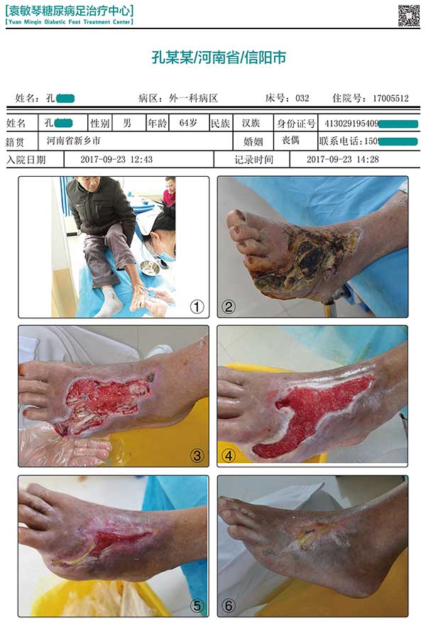 糖尿病足的治疗有什么特点?糖尿病足能治好吗?