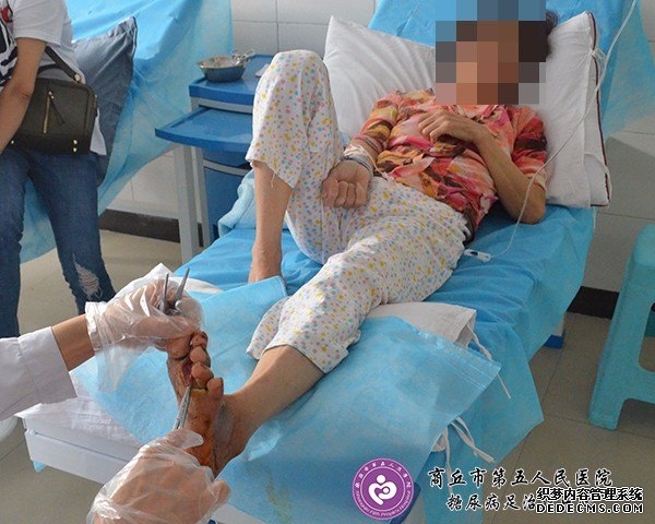 糖尿病足从郑大一附院转入我院治疗一例
